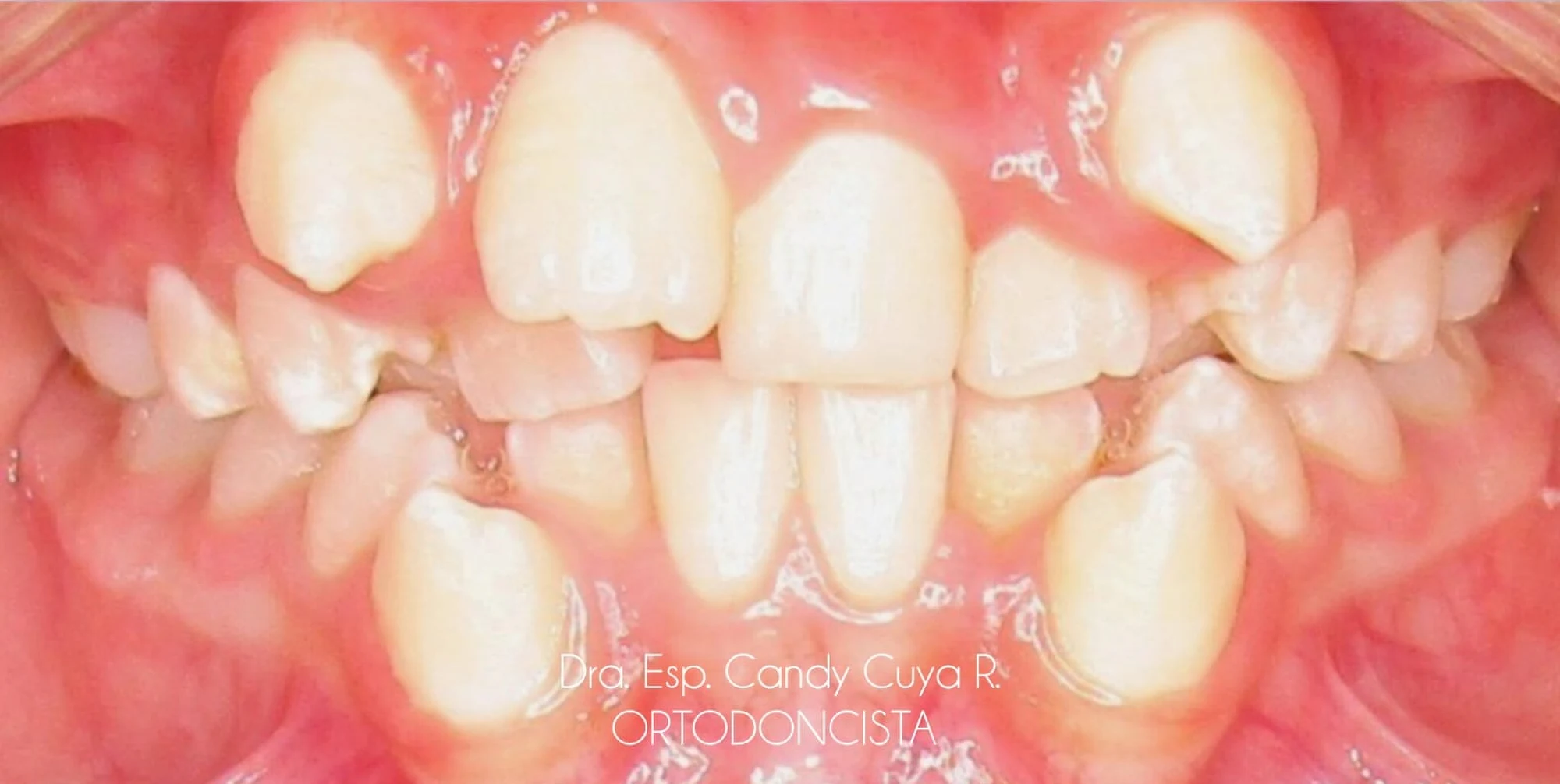 Vista intraoral frontal antes del tratamiento de ortodoncia